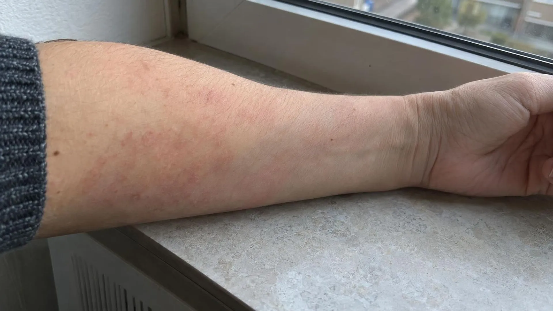 Close-up van een onderarm met rode vlekjes, rustend op een vensterbank