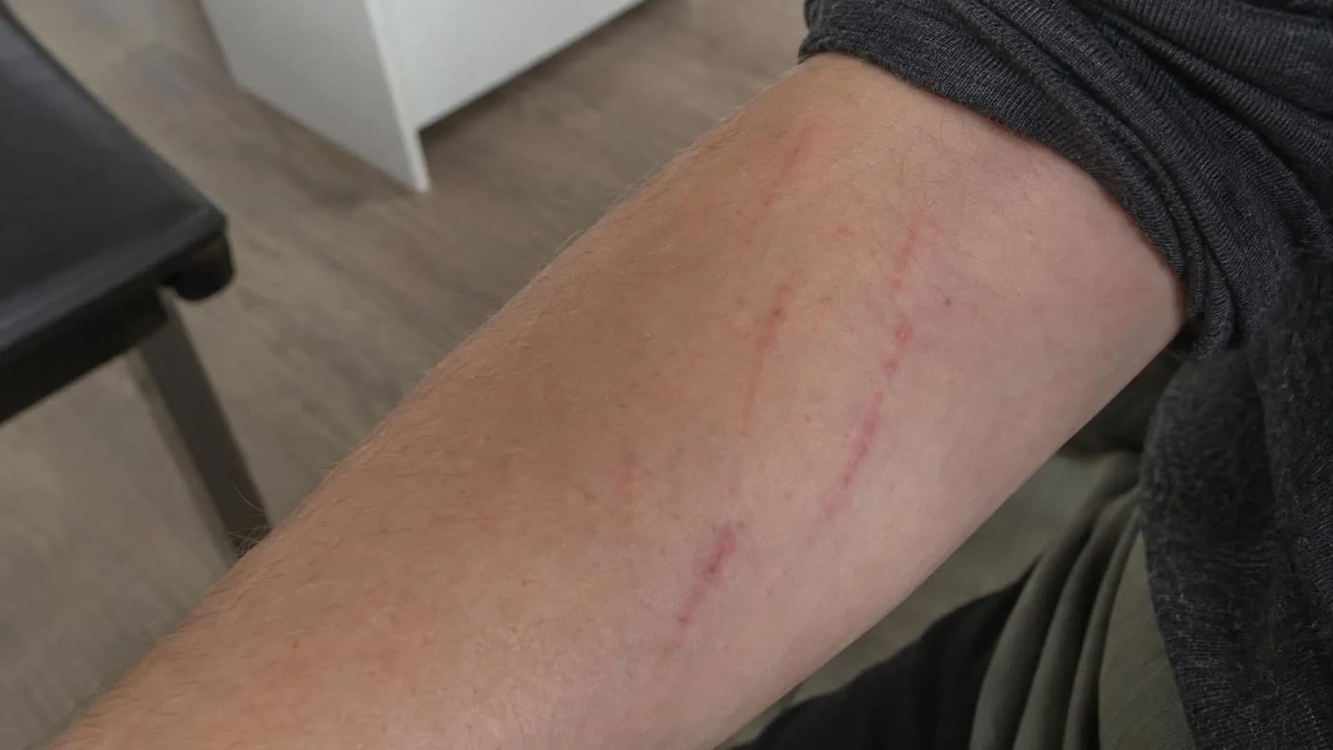 Close-up van de huid op een onderarm met lichte rode krasjes van krabben